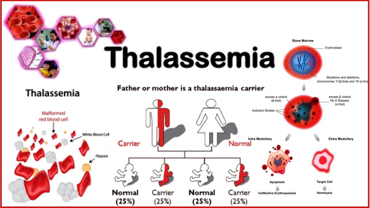 Thalassemia